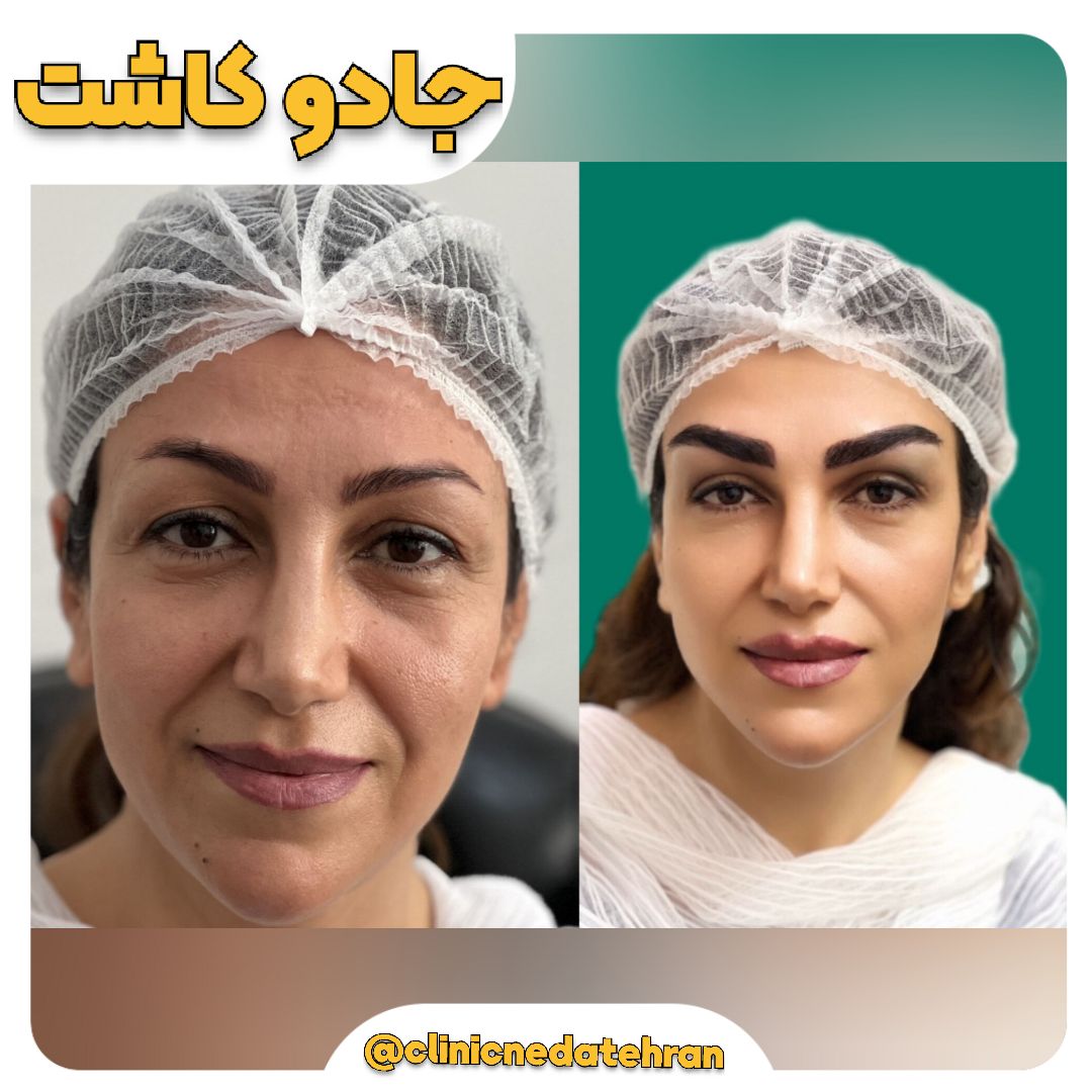 کاشت ابرو