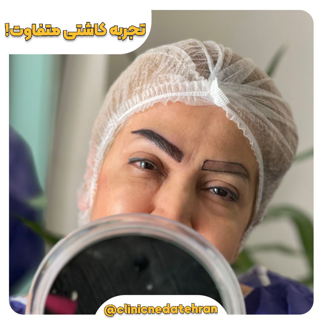 کاشت ابرو