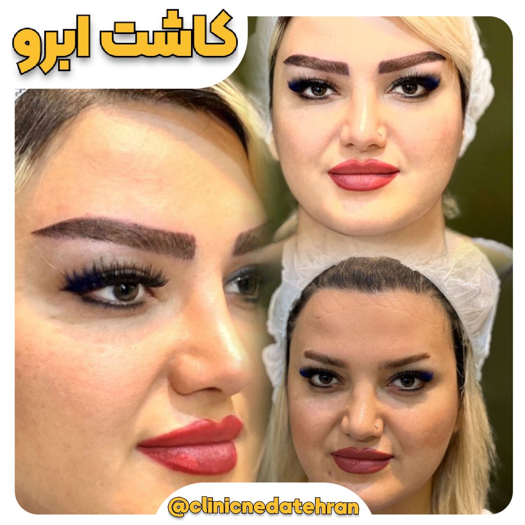 کاشت ابرو