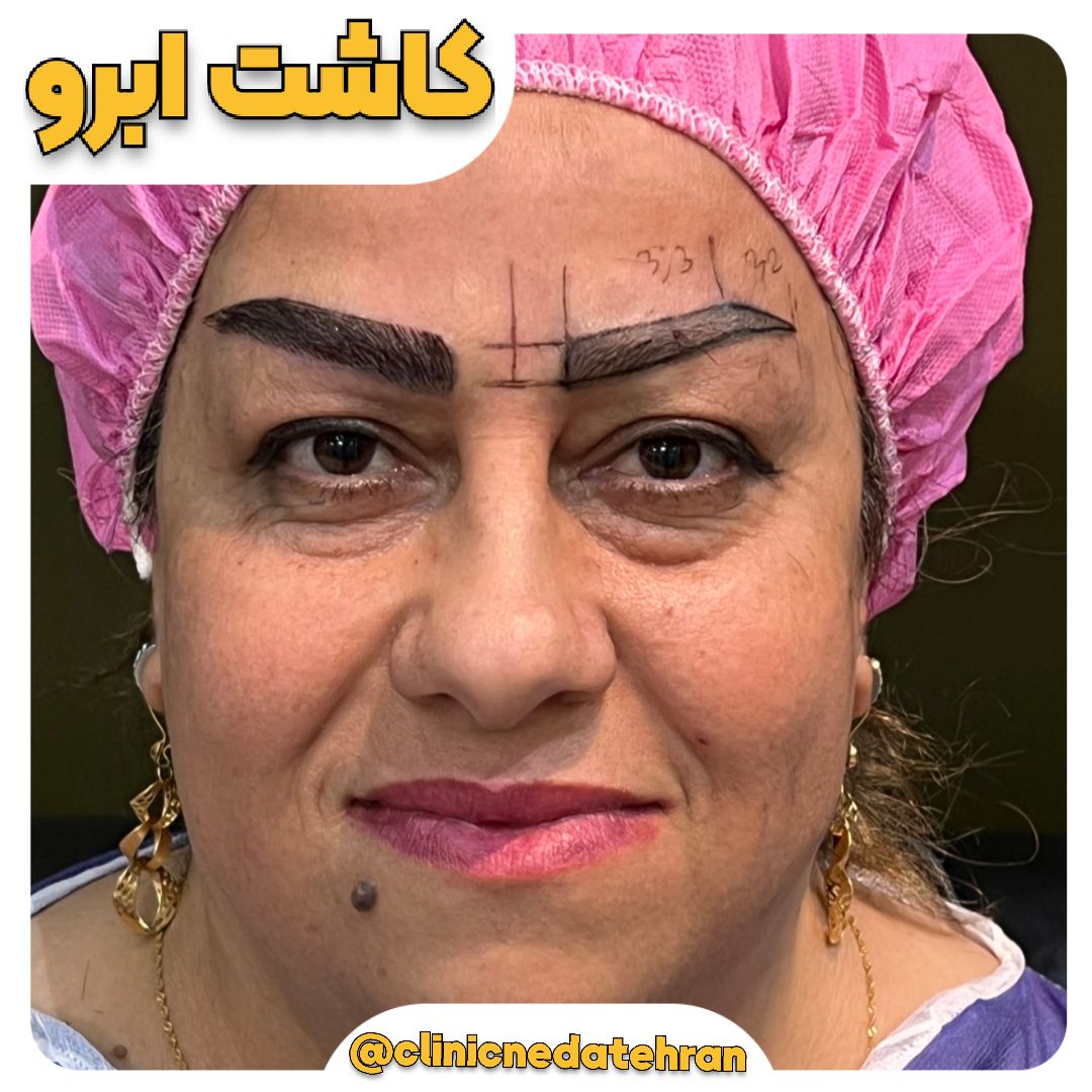 کاشت ابرو