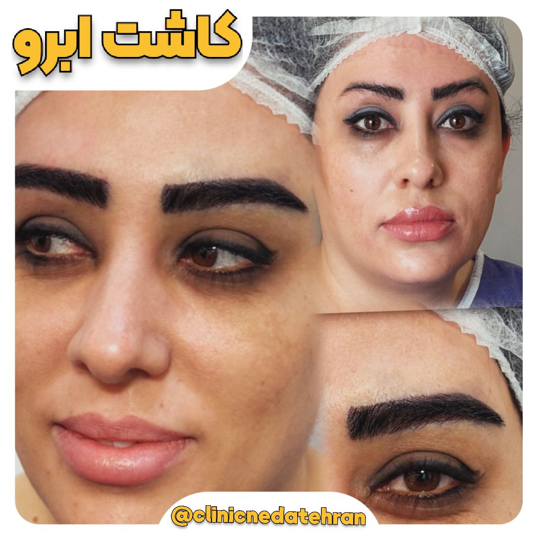 کاشت ابرو