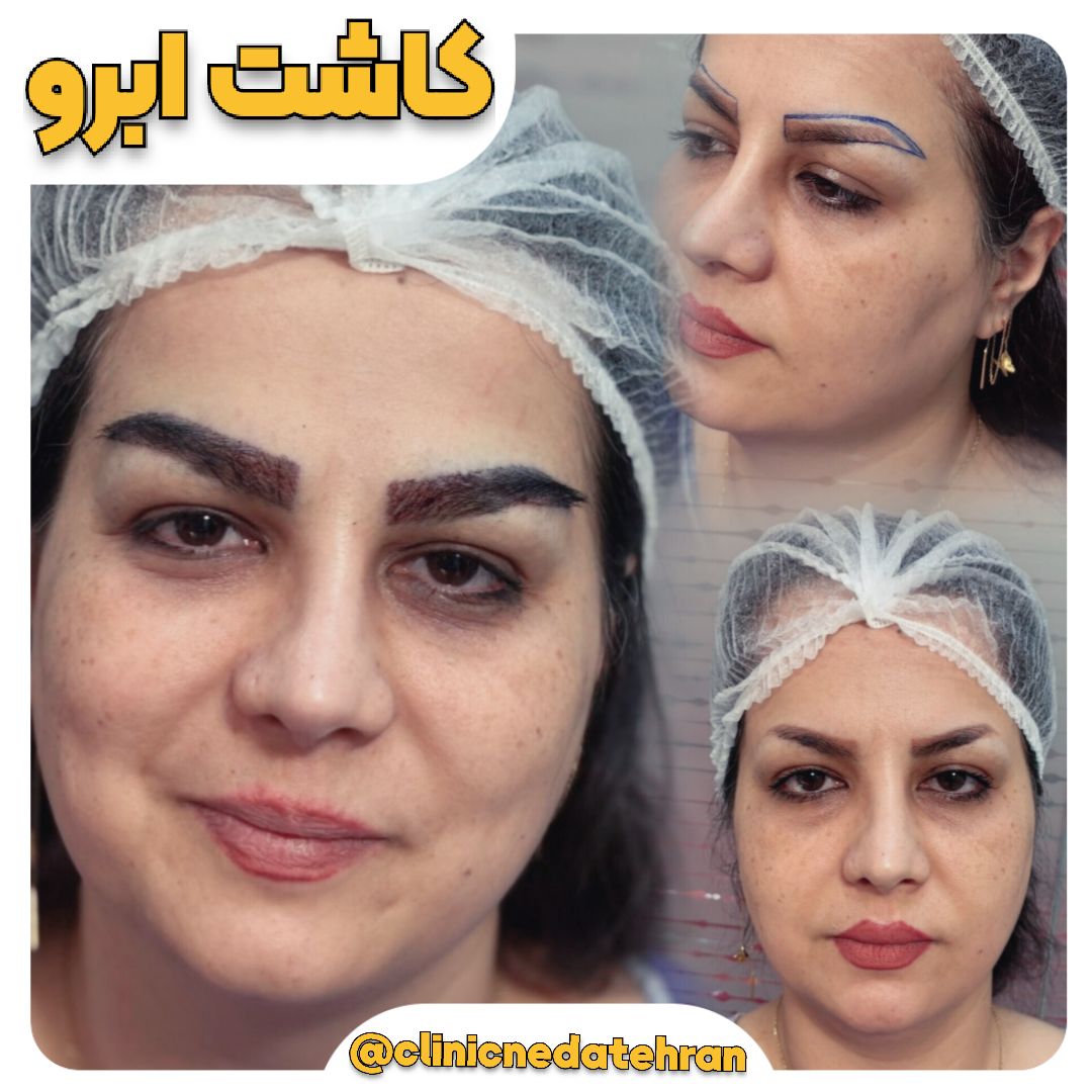 کاشت ابرو