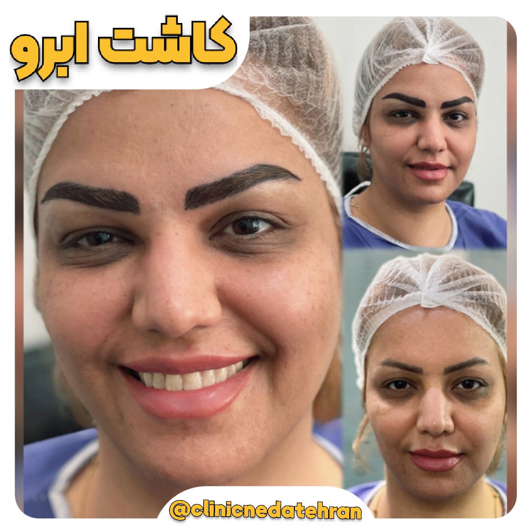 کاشت ابرو
