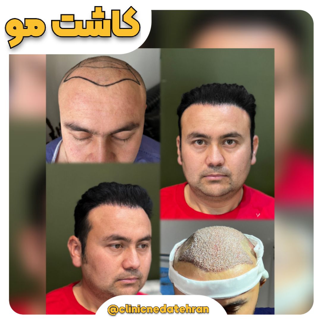 دیگر نگران موهای کم‌پشت نباشید!🚀